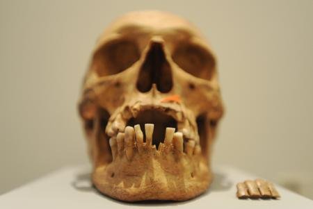 Schädel aus dem 18. Jahrhundert mit Zahnersatz aus Tierknochen.