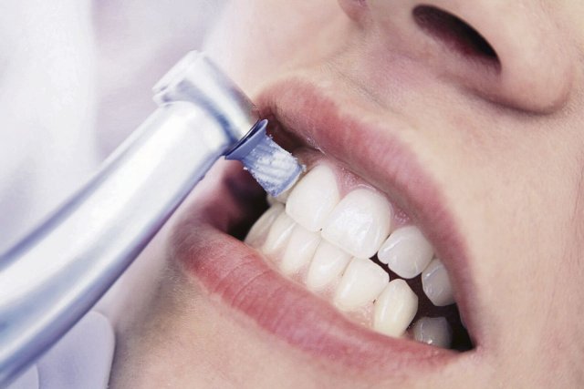 Zur professionellen Zahnreinigung gehört auch das Polieren gegen Ende der Behandlung.