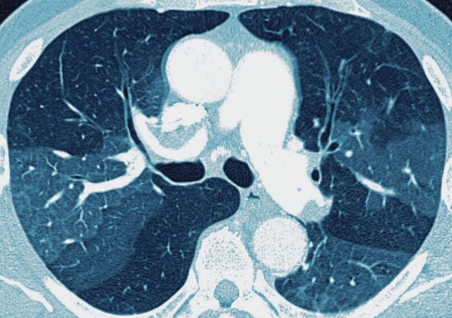 Überschüssiges Bindegewebe in der Lunge kann auf eine Covid-19-Infektion hinweisen. Der Patient leidet dann unter Atembeschwerden.
