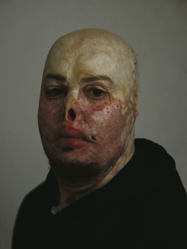 Igor Babenko suffered severe burns during the war. Today, he works with veterans at the rehabilitation center.