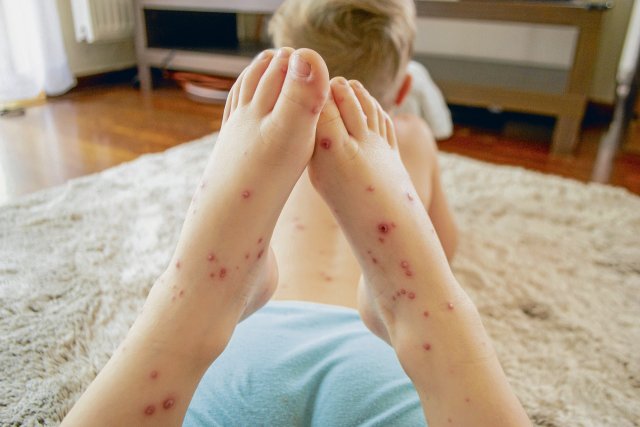 Im Gegensatz zur Gürtelrose finden sich die Pusteln bei Windpocken am ganzen Körper.