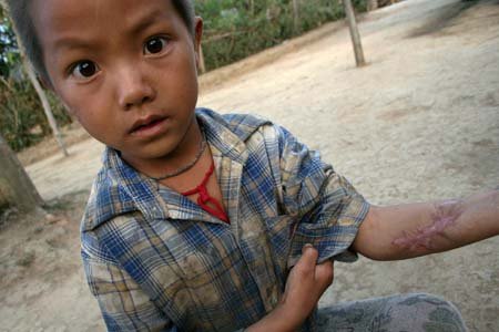 Der sechsjährige Ya Vue, ein Hmong-Junge, trägt eine große Narbe an seinem Unterarm. Durch eine Streubombenexplosion verlor er überdies den kleinen Finger der rechten Hand.
